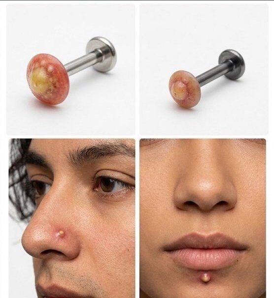 Yeni Trend Yok Artık Dedirtti! Sivilce Görünümlü Piercingler Olay Yarattı