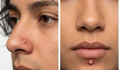 Yeni Trend Yok Artık Dedirtti! Sivilce Görünümlü Piercingler Olay Yarattı