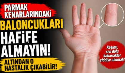 Parmak Kenarlarındaki Baloncukları Hafife Almayın: Altından O Hastalık Çıkabilir!