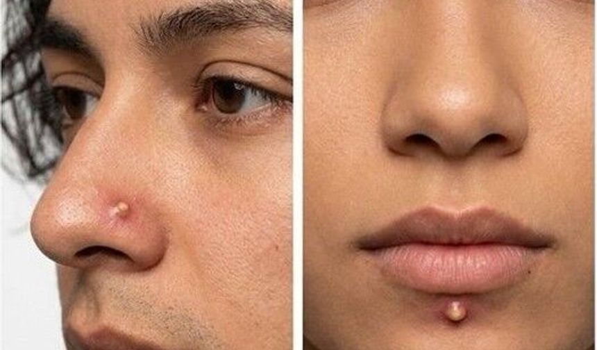 Yeni Trend Yok Artık Dedirtti! Sivilce Görünümlü Piercingler Olay Yarattı